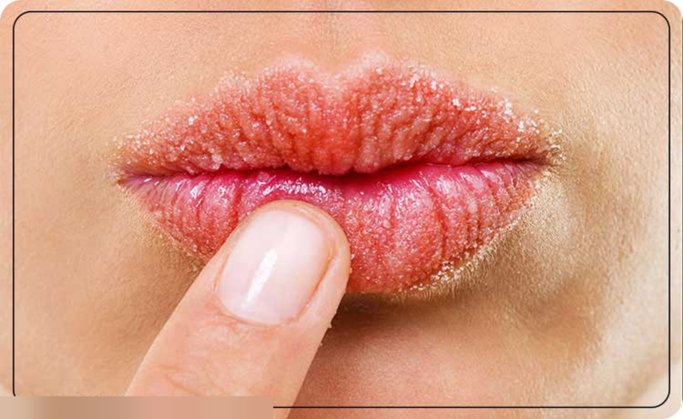 علت پوسته پوسته شدن لب و درمان آن | راه‌کارهای خانگی و پزشکی