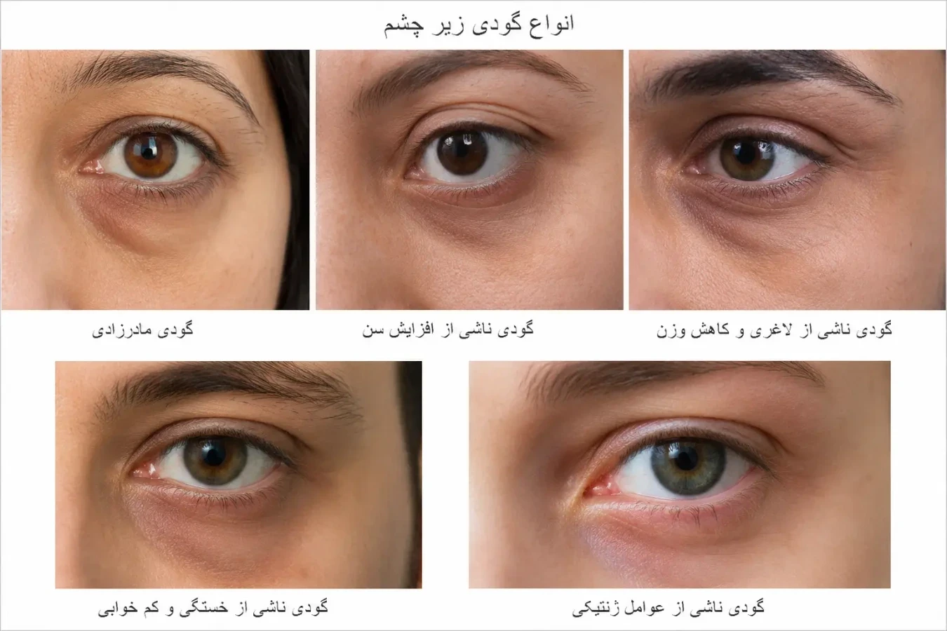 راهنمای رفع تیرگی و گودی زیر چشم با روشهای خانگی و کلینیکی